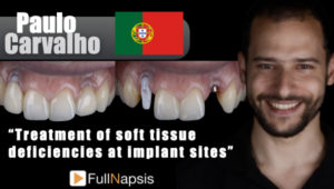 Paulo-Carvalho-treatment-of-sof-tissue-deficiencies-at-implant-sites600x340.001